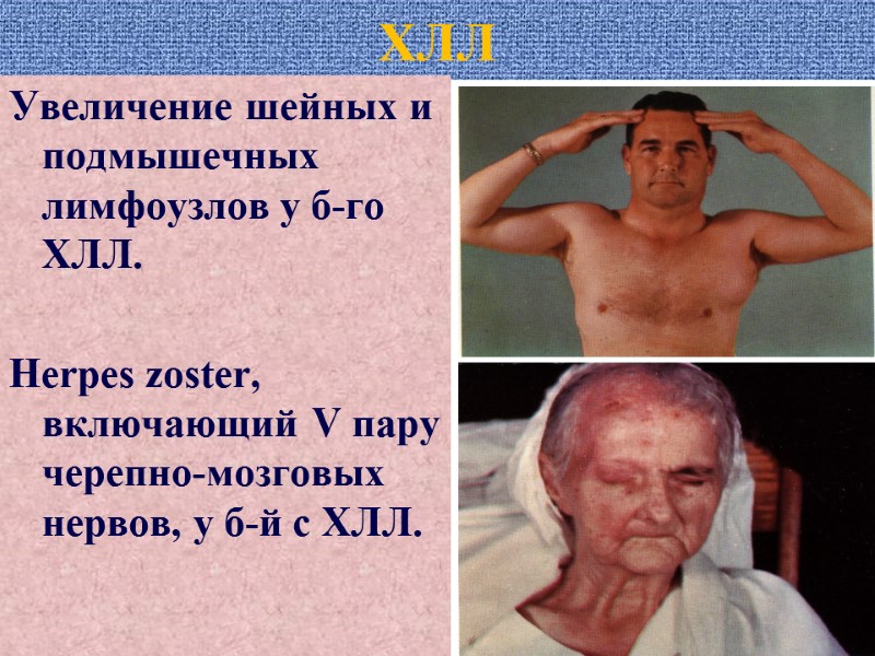 ХЛЛ Увеличение шейных и подмышечных лимфоузлов у б-го ХЛЛ.  Herpes zoster, включающий V